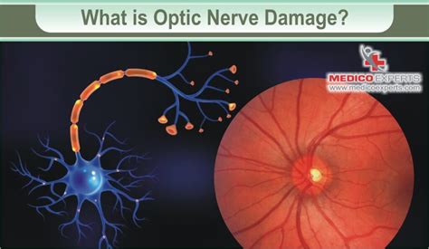 test to check how thickness of optic nerve|can optic nerve damage be detected.